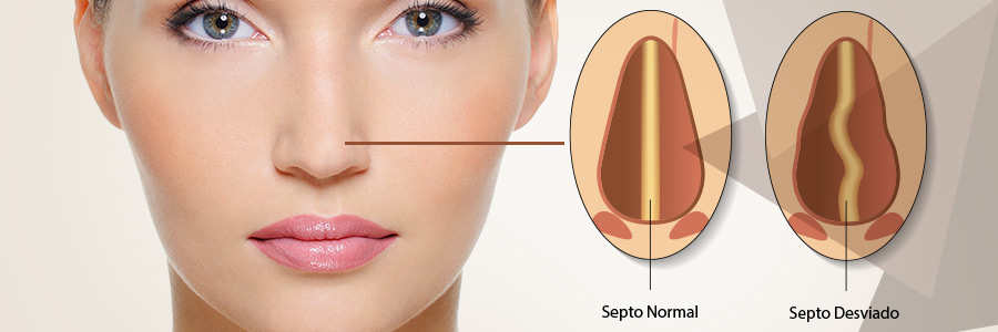 Desvio Septo