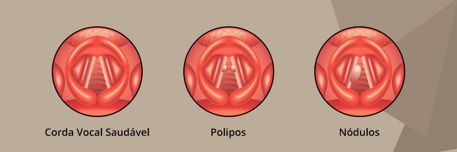 Pólipos e Nódulos