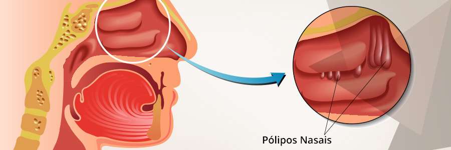 Polipose Nasal
