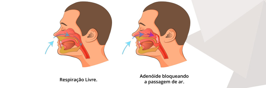 Adenoidectomia