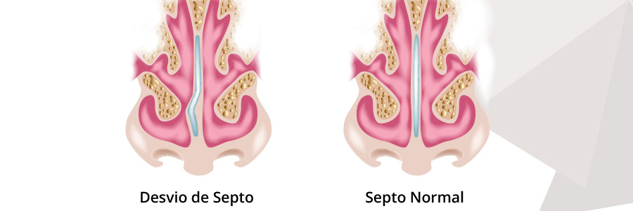 Cirurgia Nariz