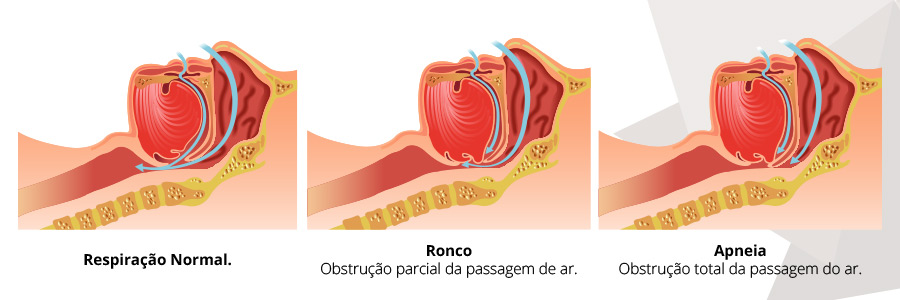 Ronco e Apnéia