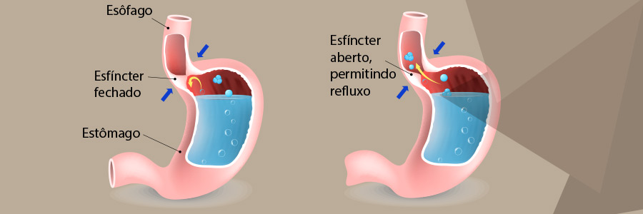 Refluxo